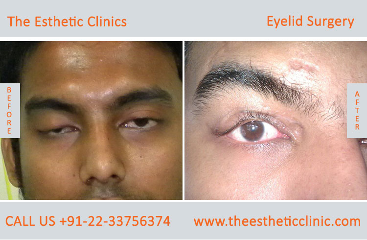 Toronto Blepharoplasty Eyelid Surgery  TPS