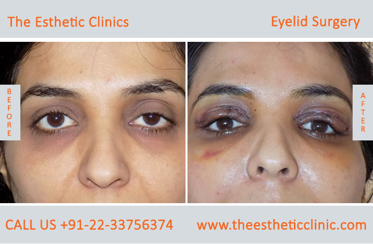 ptosis surgery cost