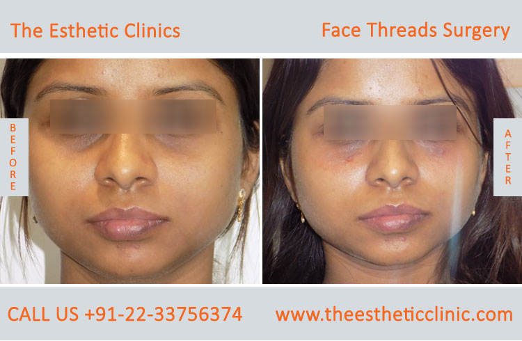 Thread Lift Surgery Mumbai, Face Lifting with Threads, Cost in India - The  Esthetic Clinics