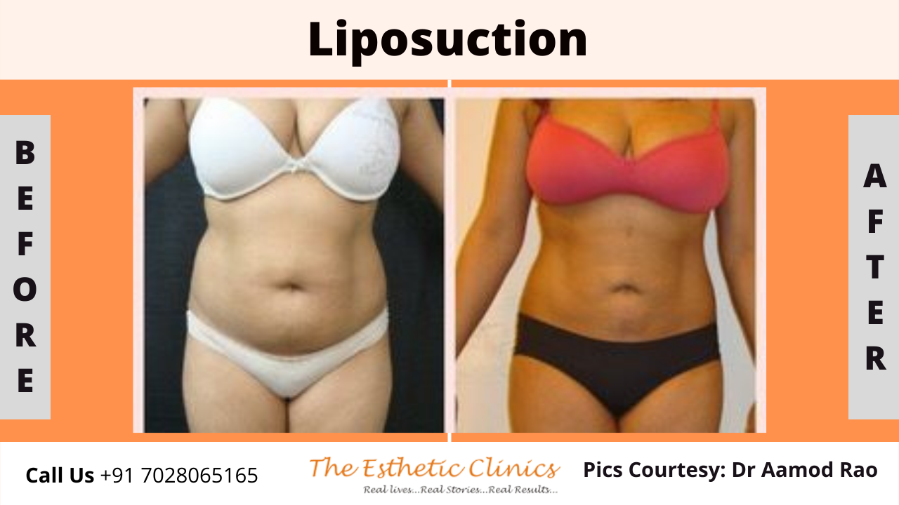 Body Contouring Surgery in Mumbai, Coolsculpting Cost India - The Esthetic  Clinics