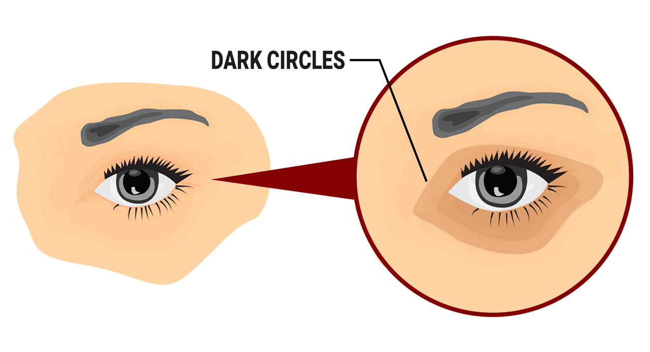 Best Dark Circle Treatment in Mumbai at Affordable Price Cost India by Dr Rinky Kapoor at The Esthetic Clinics