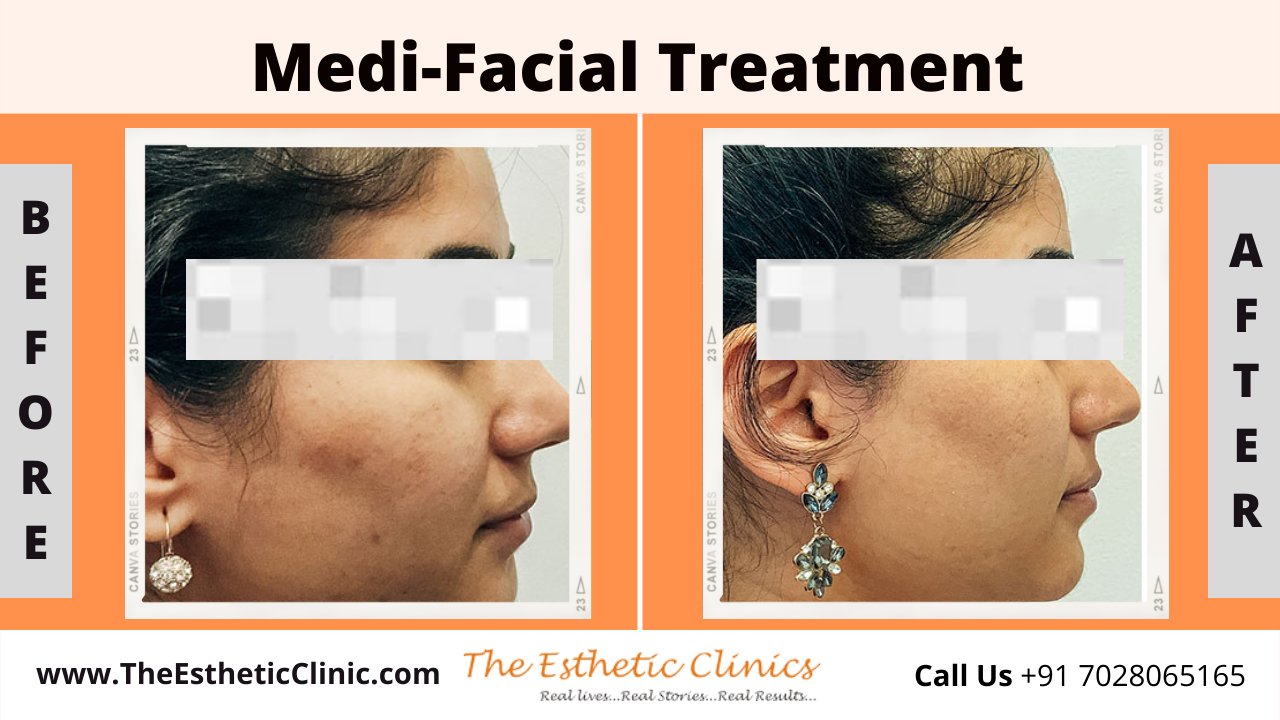 Medi-Facial Treatment before after photos in mumbai india